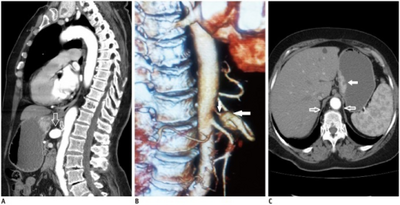 Median arcuate ligament syndrome-a)Stenosis and aneurysm of celiac artery because of compression arrows b)severe stenosis and poststenotic dilatation white arrow c) median arcuate ligaments arrows and gastric mucasal thickening