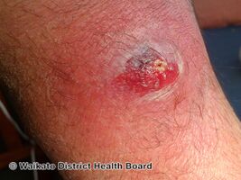 Wound infection -bacterial