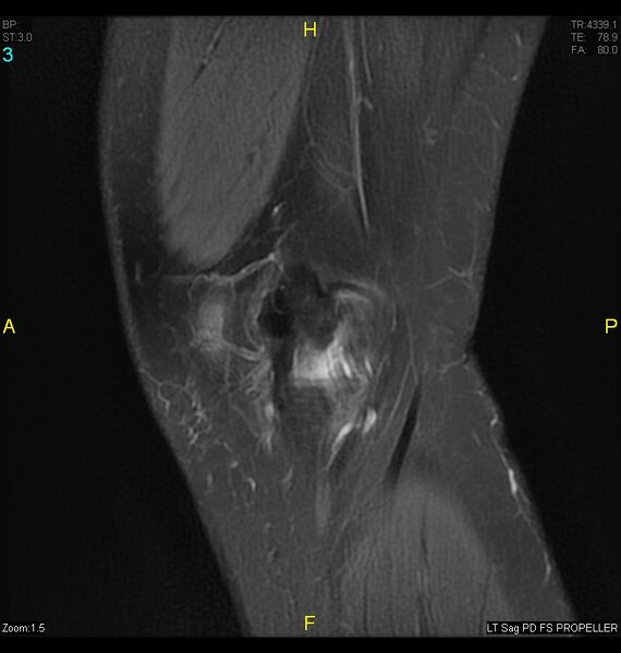 File:ACL mucoid degeration with cystic changes (Radiopaedia 48428-53341 Sagittal PD fat sat 1).jpg
