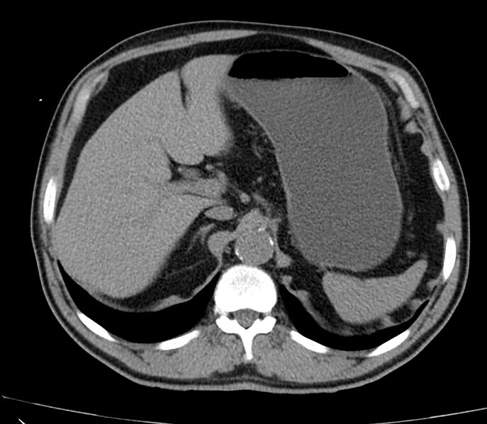 File:Abdominal aortic aneurysm (Radiopaedia 22421-22458 non-contrast 12).jpg