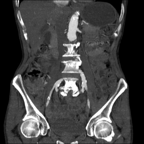 File:Abdominal aortic aneurysm (Radiopaedia 23703-23856 Coronal C+ arterial phase 13).jpg