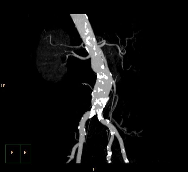 File:Abdominal aortic aneurysm (Radiopaedia 23703-23856 MIP 11).jpg