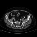 Abdominal aortic aneurysm (Radiopaedia 25855-26001 Axial C+ arterial phase 104).jpg