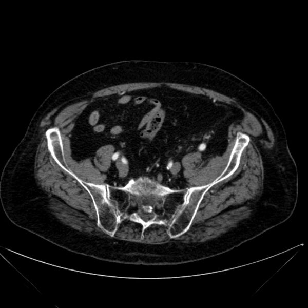 File:Abdominal aortic aneurysm (Radiopaedia 25855-26001 Axial C+ arterial phase 104).jpg