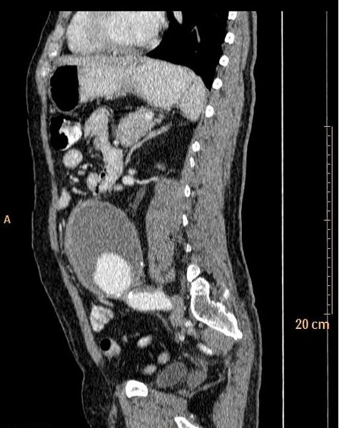 File:Abdominal aortic aneurysm (Radiopaedia 25985-26121 Sagittal C+ arterial phase 4).jpg