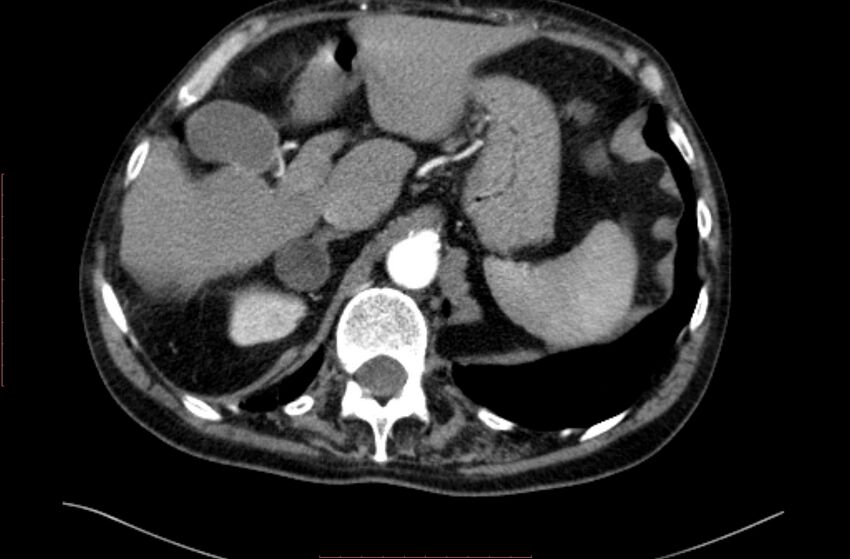 Abdominal aortic interposition tube graft and aneurysm thrombosis (Radiopaedia 71438-81857 Axial C+ arterial phase 8).jpg