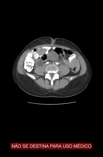 File:Abdominal desmoid tumor (Radiopaedia 44024-47540 Axial C+ arterial phase 22).jpg
