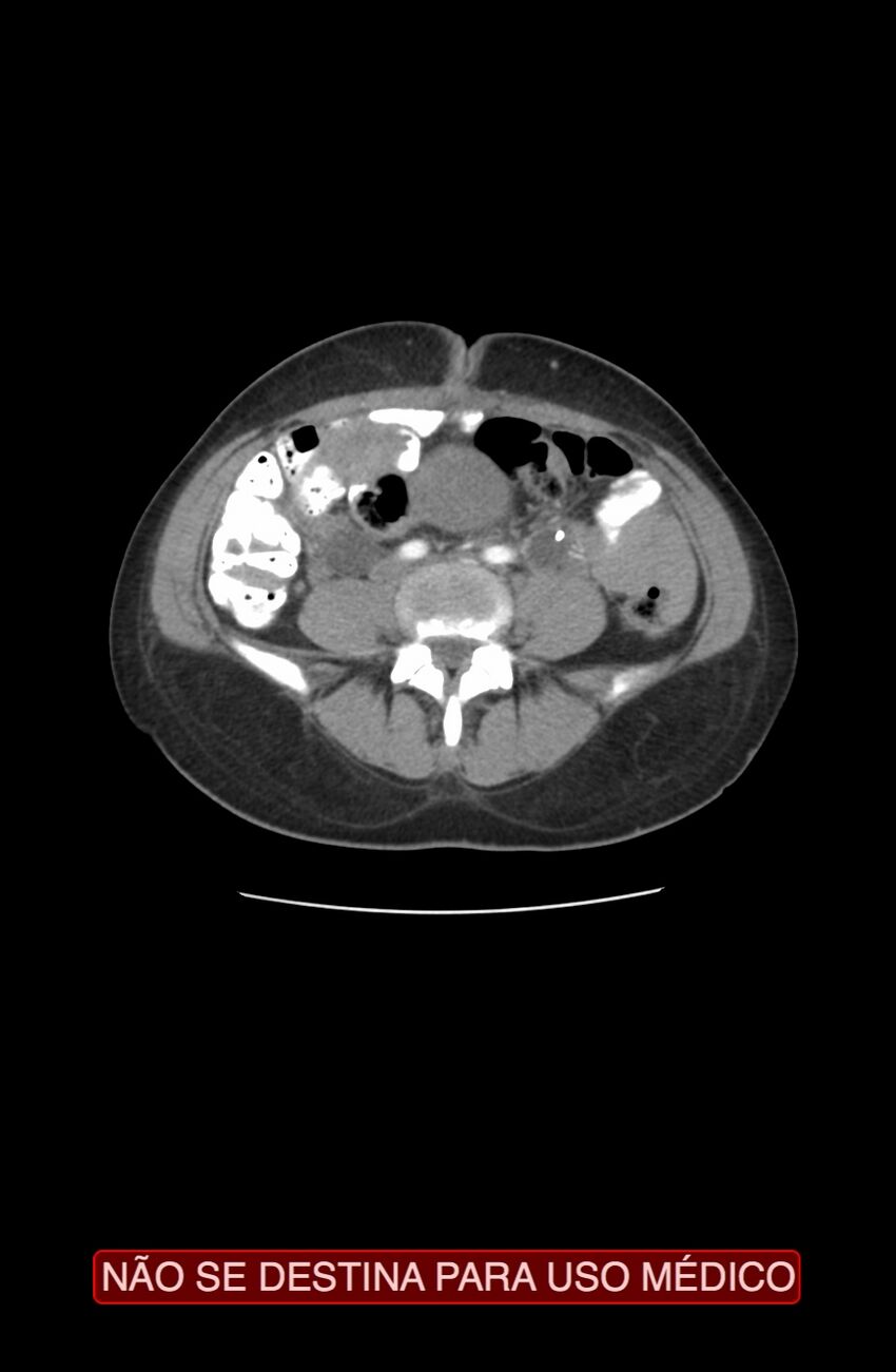 Abdominal desmoid tumor (Radiopaedia 44024-47540 Axial C+ arterial phase 22).jpg