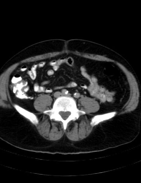 File:Abdominal lymphoma - with sandwich sign (Radiopaedia 53486-59492 Axial C+ portal venous phase 33).jpg