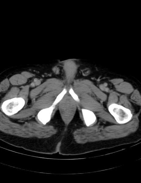 File:Abdominal lymphoma - with sandwich sign (Radiopaedia 53486-59492 Axial C+ portal venous phase 53).jpg