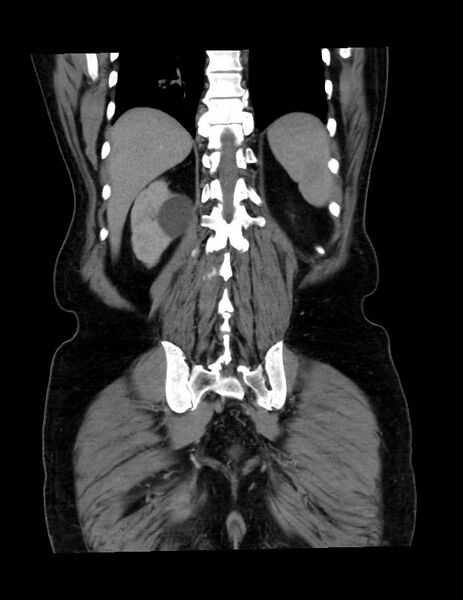 File:Abdominal lymphoma - with sandwich sign (Radiopaedia 53486-59492 C+ portal venous phase 11).jpg