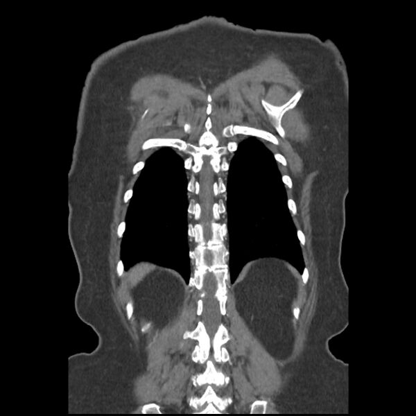 File:Aberrant right subclavian and left vertebral arteries (Radiopaedia 43467-46847 Coronal C+ portal venous phase 74).jpg