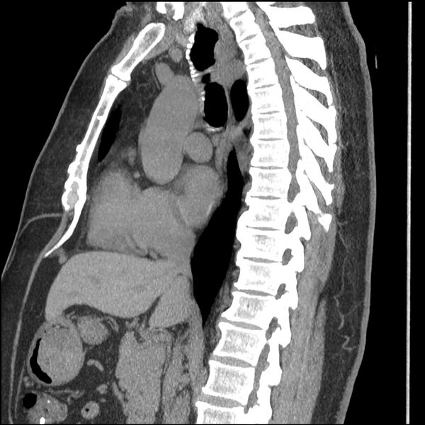 File:Aberrant right subclavian artery (Radiopaedia 40967-43680 Sagittal non-contrast 47).jpg