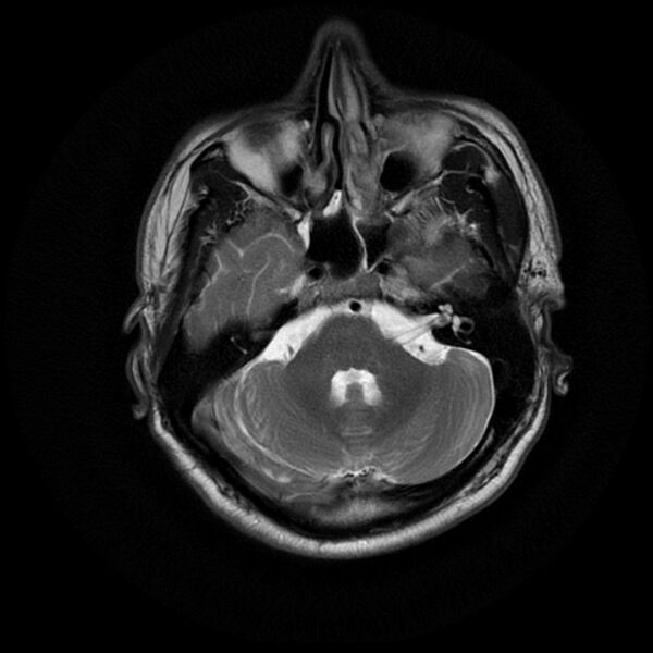 File:Acoustic schwannoma - intracanalicular (Radiopaedia 37247-39024 Axial T2 6).jpg