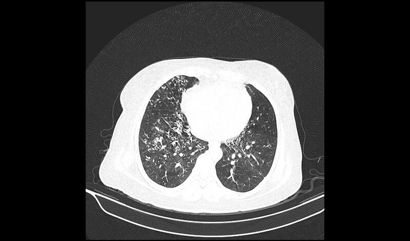 File:Acquired tracheo-esophageal fistula (Radiopaedia 51356-57103 Axial lung window 29).jpg