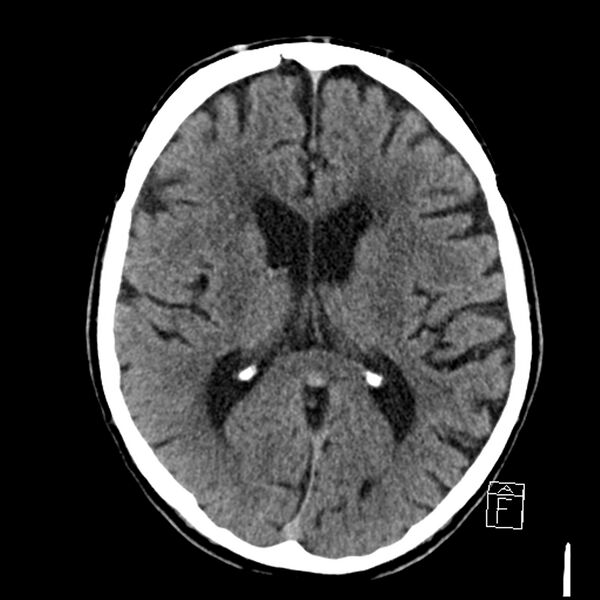 File:Acute P1 occlusion with PCA ischemia penumbra (CT perfusion) (Radiopaedia 72084-82586 Axial non-contrast 24).jpg