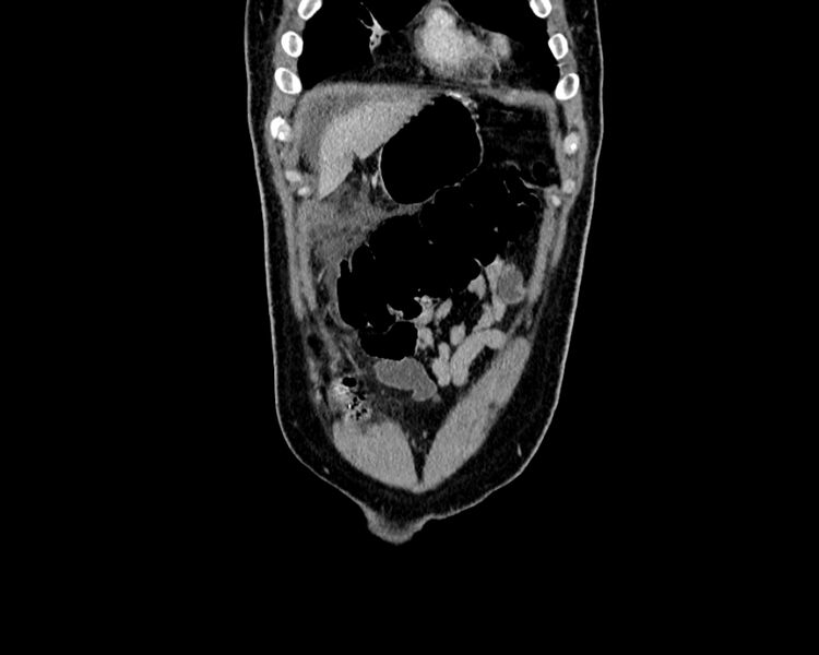 File:Acute cholecystitis (Radiopaedia 53216-59182 Coronal C+ portal venous phase 2).jpg