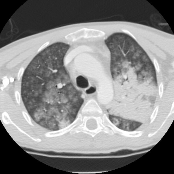File:Acute diffuse alveolar hemorrhage (Radiopaedia 41323-44158 Axial lung window 16).jpg