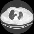 Acute heart failure (CT) (Radiopaedia 79835-93075 Axial lung window 11).png