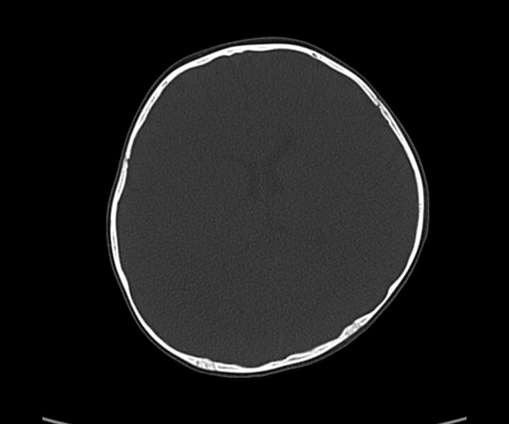 File:Acute hemorrhagic contusion (Radiopaedia 63660-72336 Axial bone window 39).jpg