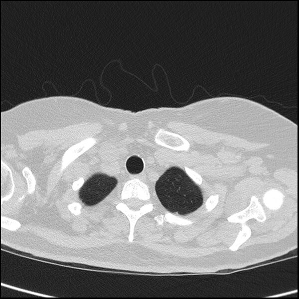 File:Acute interstitial pneumonitis (Radiopaedia 45404-49453 Axial lung window 8).jpg