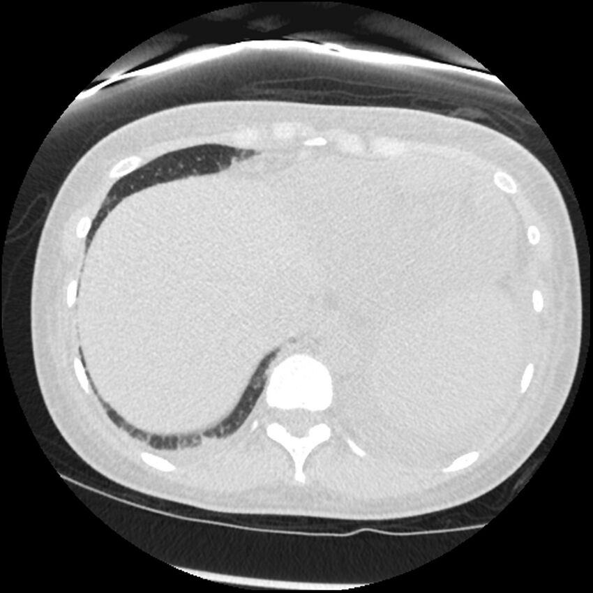 Acute lupus nephritis (Radiopaedia 45832-50107 Axial lung window 83).jpg