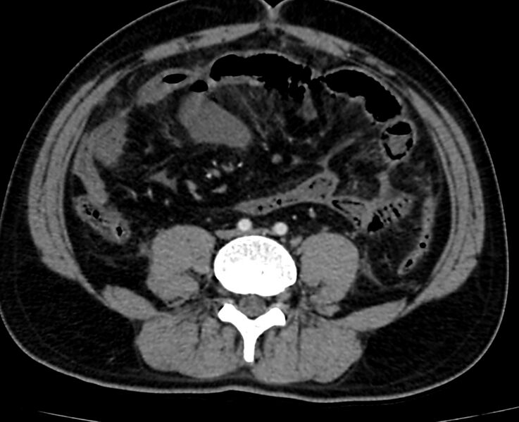 File:Acute mesenteric ischemia - superior mesenteric artery thrombosis (Radiopaedia 73947-84776 Axial C+ arterial phase 95).jpg