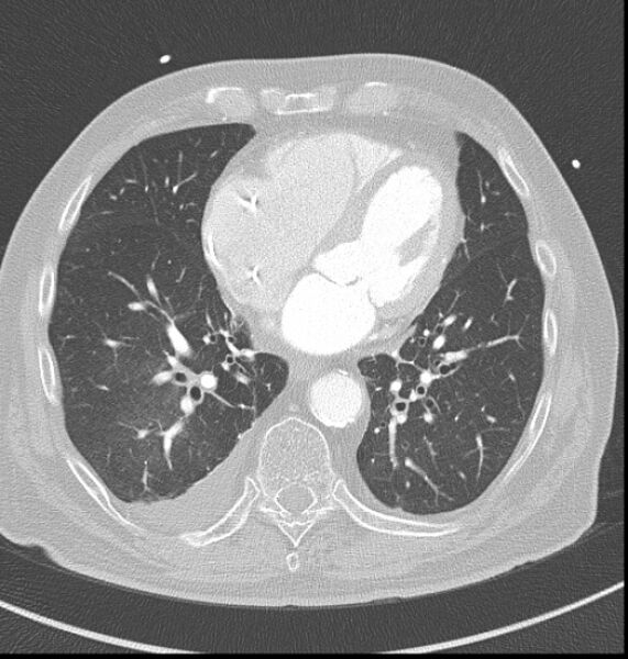 File:Acute myocardial infarction (Radiopaedia 23413-23481 lung window 45).jpg