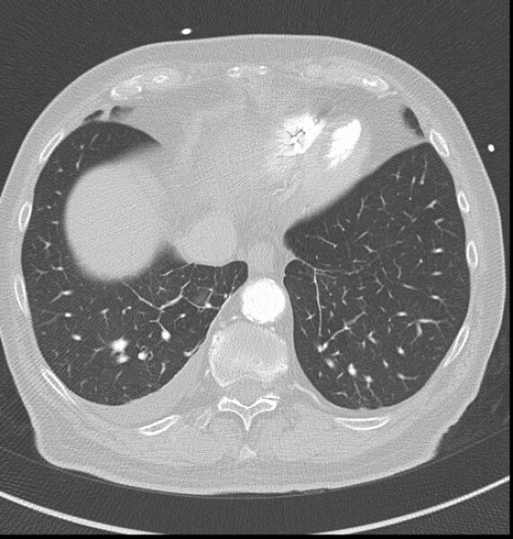 File:Acute myocardial infarction (Radiopaedia 23413-23481 lung window 59).jpg