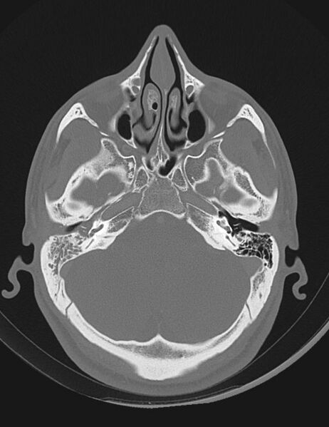 File:Acute otomastoiditis (Radiopaedia 28329-28575 Axial bone window 5).jpg