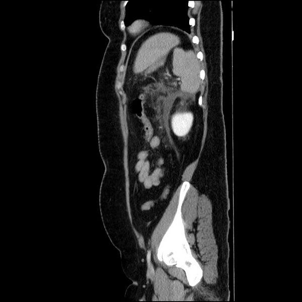 File:Acute pancreatitis (Radiopaedia 69236-79012 Sagittal C+ portal venous phase 30).jpg
