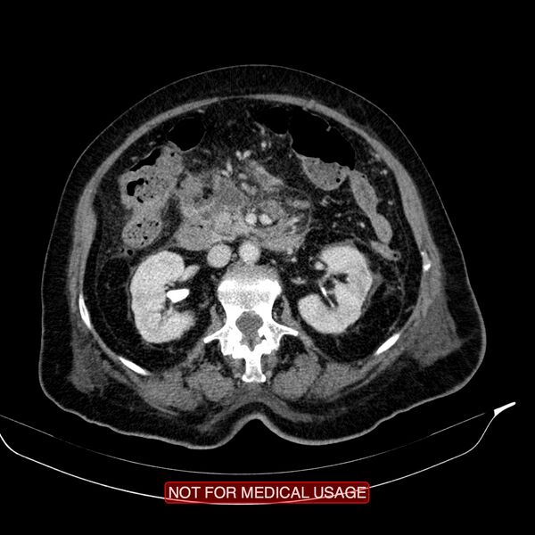 File:Acute pancreatitis with infected necrosis (Radiopaedia 26454-26585 Axial C+ portal venous phase 11).jpg