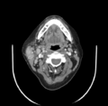 Acute parotitis (Radiopaedia 27425-27619 Axial C+ portal venous phase 32).png