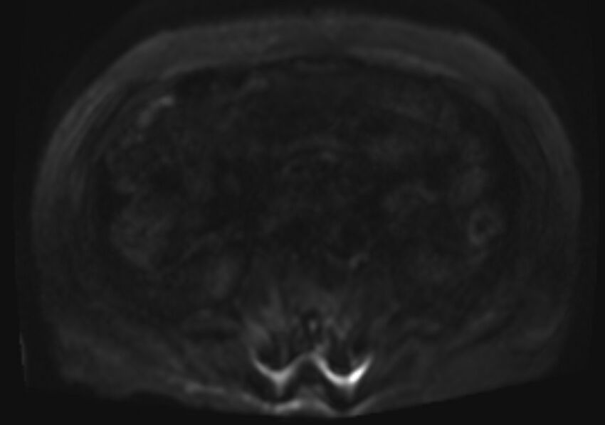 Acute portal vein thrombosis (Radiopaedia 73198-83925 Axial DWI 55).jpg