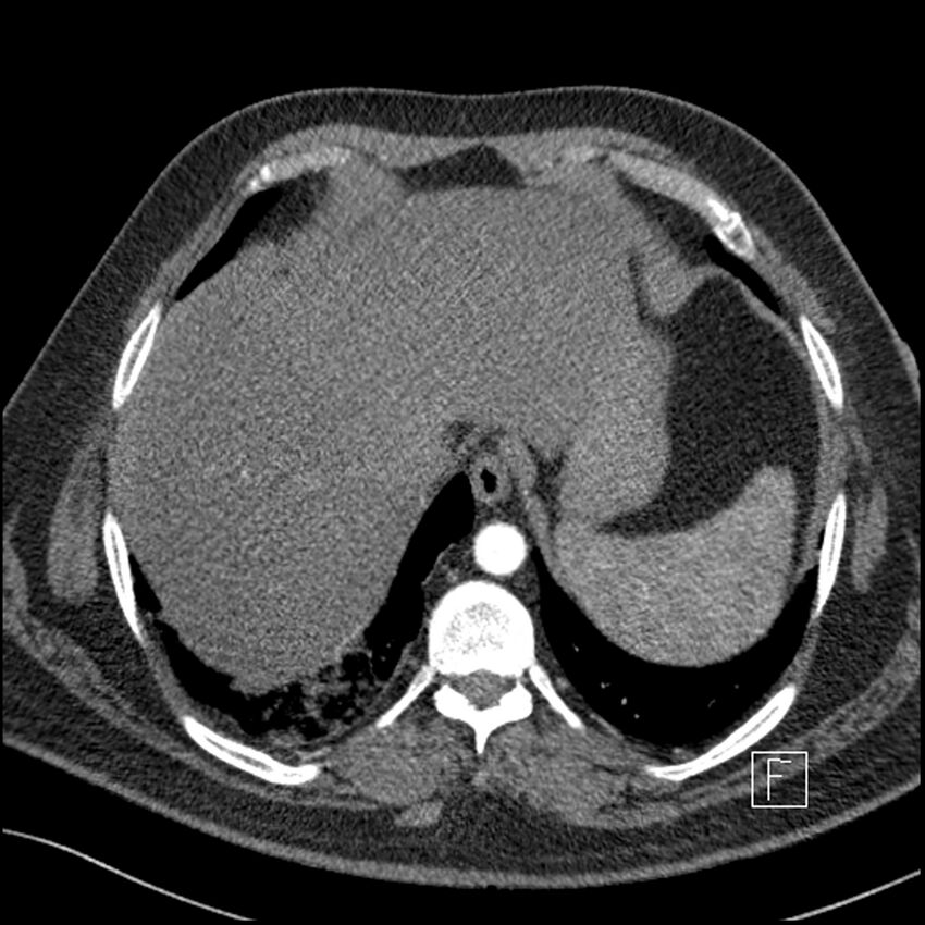 Acute pulmonary embolism with pulmonary infarct (Radiopaedia 73062-83768 Axial C+ CTPA 66).jpg
