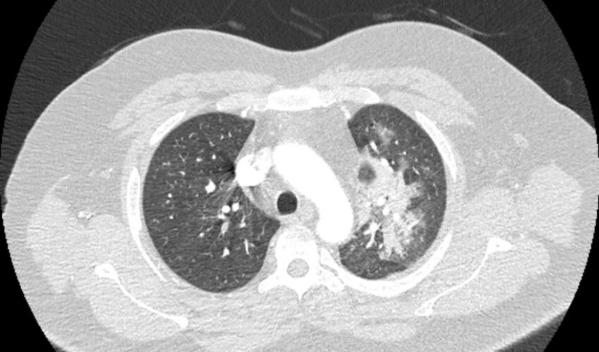 Acute pulmonary embolism with pulmonary infarcts (Radiopaedia 77688-89908 Axial lung window 25).jpg