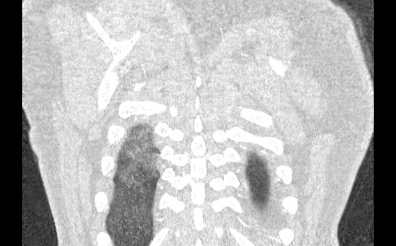File:Acute pulmonary embolism with pulmonary infarcts (Radiopaedia 77688-89908 Coronal lung window 100).jpg