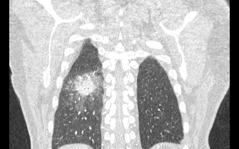 File:Acute pulmonary embolism with pulmonary infarcts (Radiopaedia 77688-89908 Coronal lung window 90).jpg