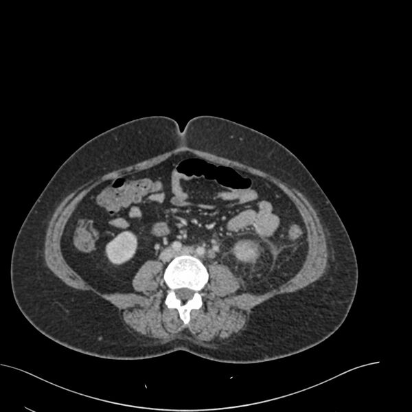 File:Acute pyelonephritis with renal vein thrombosis (Radiopaedia 58020-65053 Axial renal parenchymal phase 127).jpg