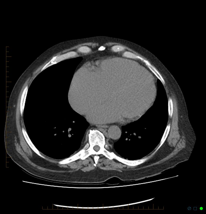 Acute renal failure post IV contrast injection- CT findings (Radiopaedia 47815-52557 Axial non-contrast 3).jpg