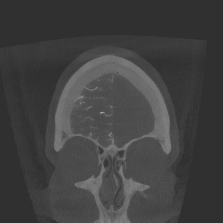 Acute subarachnoid hemorrhage and accessory anterior cerebral artery (Radiopaedia 69231-79010 Coronal arterial - MIP 11).jpg