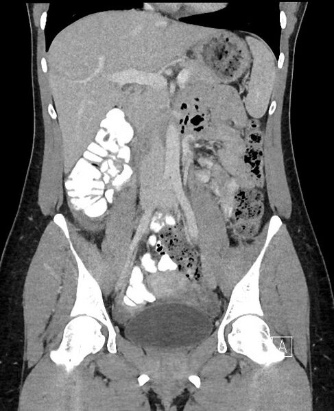 File:Acute uncomplicated appendicitis (Radiopaedia 61374-69304 Coronal C+ portal venous phase 48).jpg