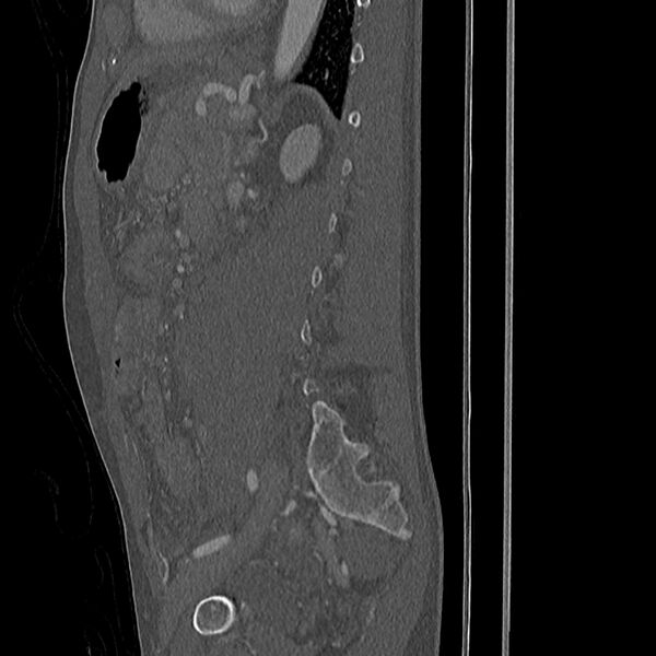 File:Acute vertebral body compression fractures (Radiopaedia 31757-32693 Sagittal bone window 9).jpg
