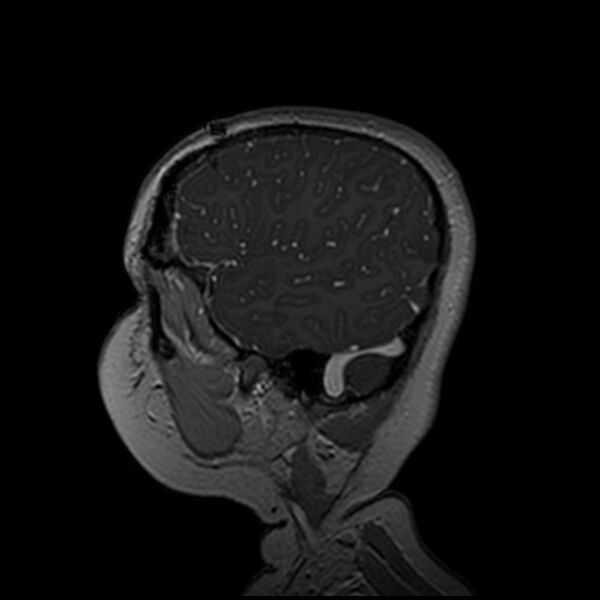 File:Adamantinomatous craniopharyngioma (Radiopaedia 77407-89529 H 101).jpg