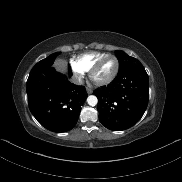 File:Adenocarcinoma of the lung (Radiopaedia 44205-47803 Axial C+ portal venous phase 62).jpg
