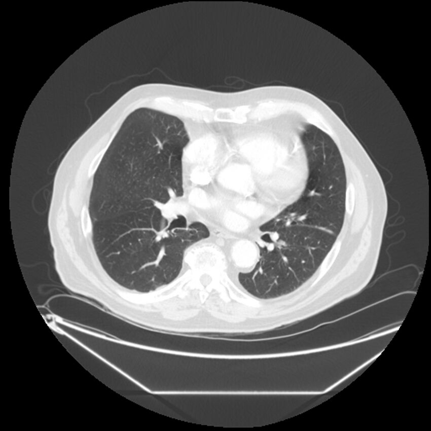 Adenocarcinoma of the lung (Radiopaedia 44876-48759 Axial lung window 44).jpg