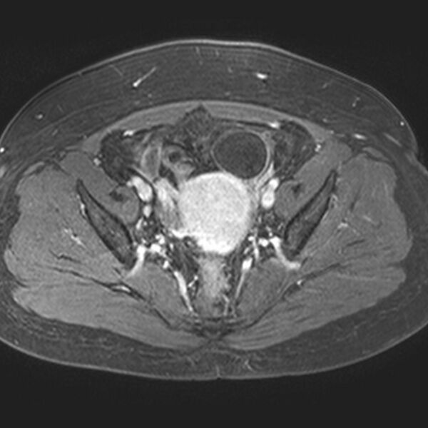 File:Adenomyoma of the uterus (Radiopaedia 9871-10439 Axial T1 C+ fat sat 15).jpg