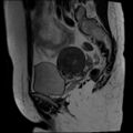 Adenomyosis and endometriotic cysts (Radiopaedia 82300-96367 Sagittal T2 6).jpg