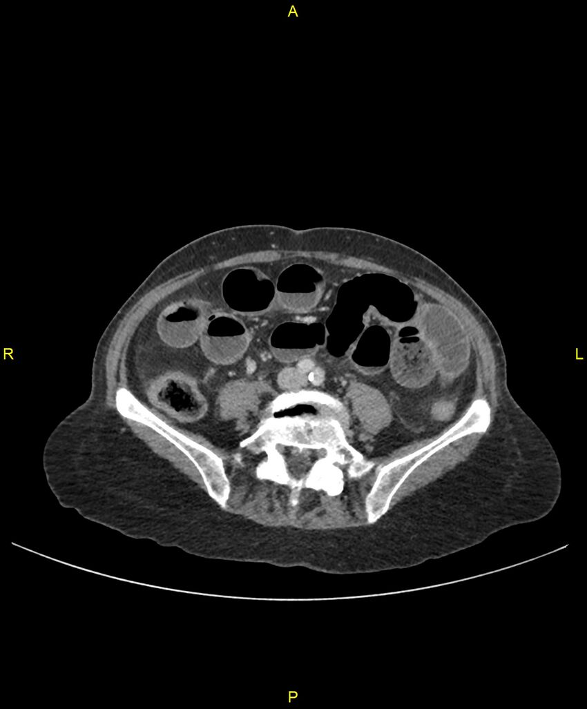 Adhesional small bowel obstruction (Radiopaedia 85402-101024 Axial C+ portal venous phase 179).jpg