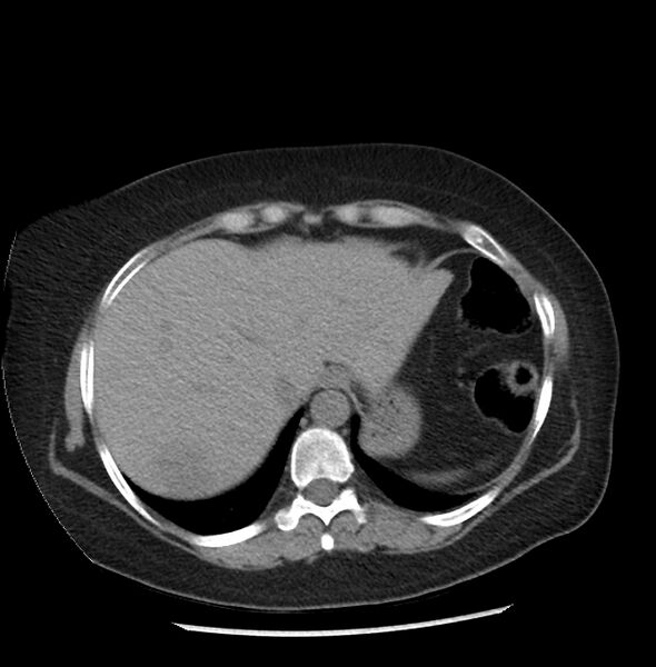 File:Adrenal cortical carcinoma with IVC invasion and thrombosis (Radiopaedia 34307-35597 Axial non-contrast 2).jpg